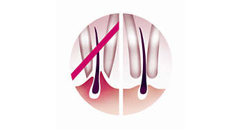 Gentle tweezing discs remove hair without pulling skin