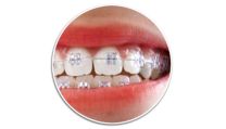 Safe on braces and brackets *4