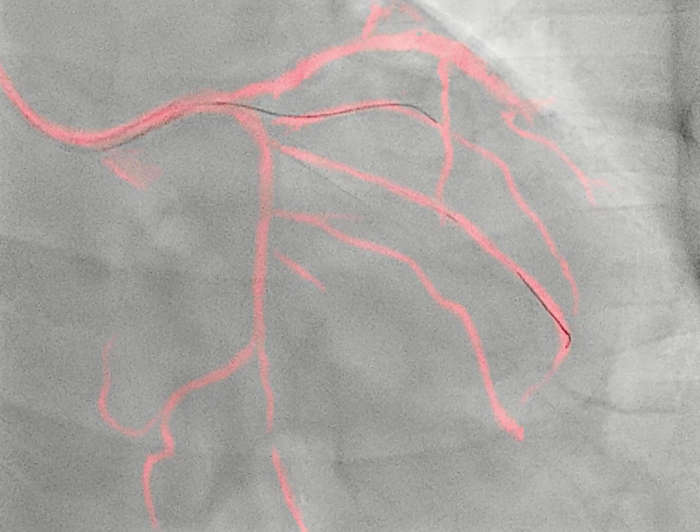 Philips Dynamic Coronary Roadmap