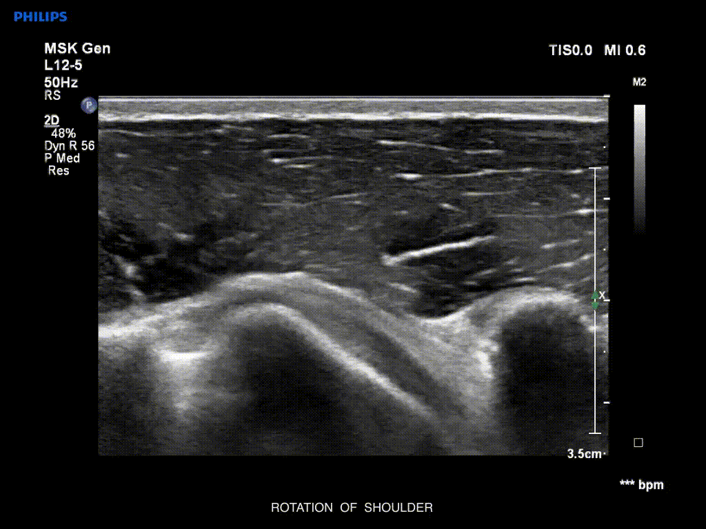 Rotation of shoulder
