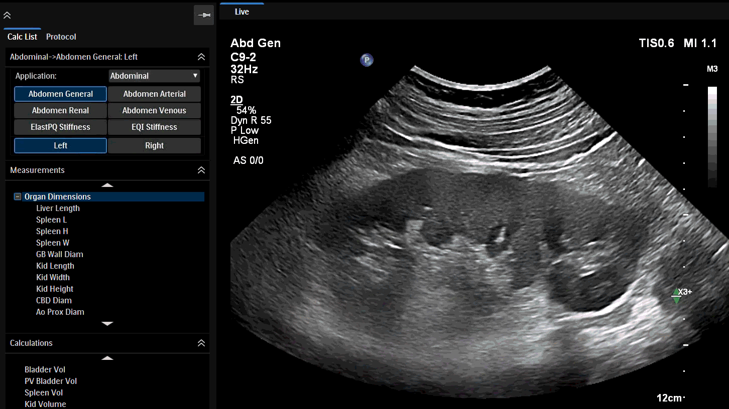 Clinical video using EPIQ Elite and C9-2 transducer showing left kidney with auto measure 