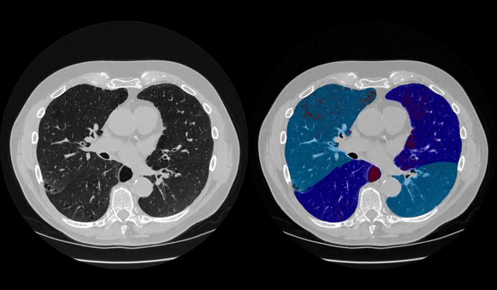 Lung Density Analysis (LDA™), Inspiratory (LDAi)