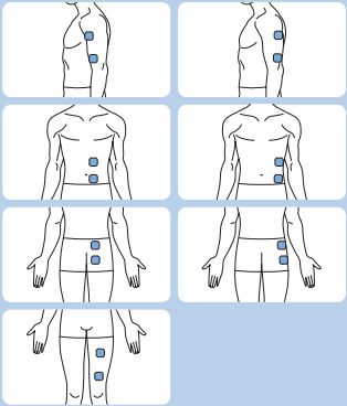 Electrode Placement for Electric Stimulation Charts