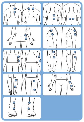 Electrode placement for TENS