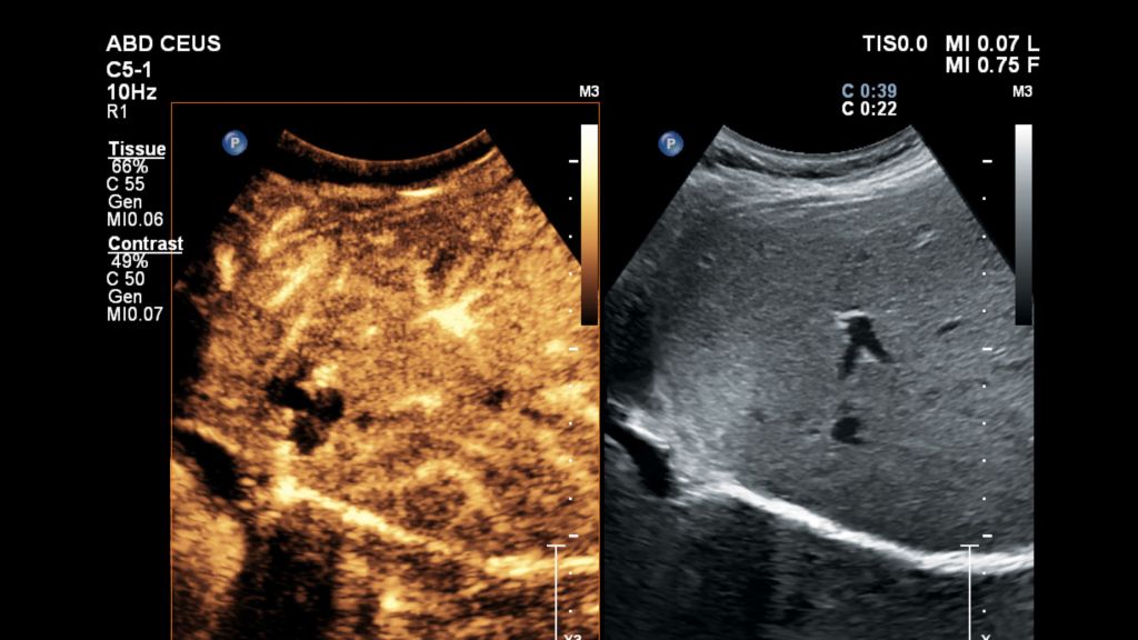 Liver CEUS