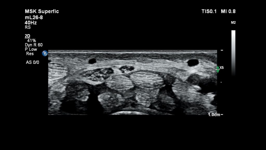 Nerve ultrasound