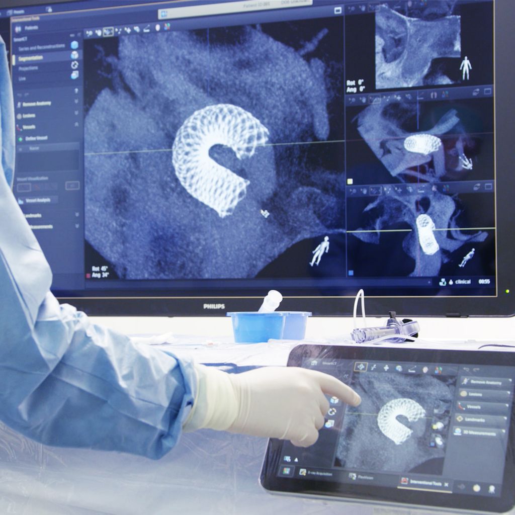 3D visualization beyond the clot