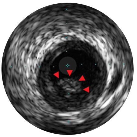 Disease diagnosis using Philips IVUS technology