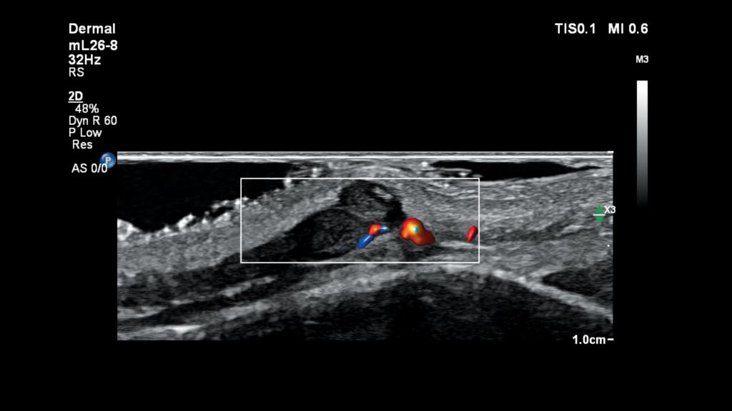 Dermal ultrasound