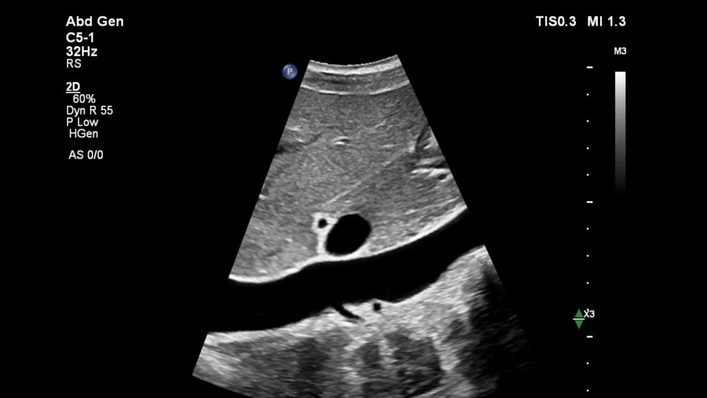 Inferior vena cava