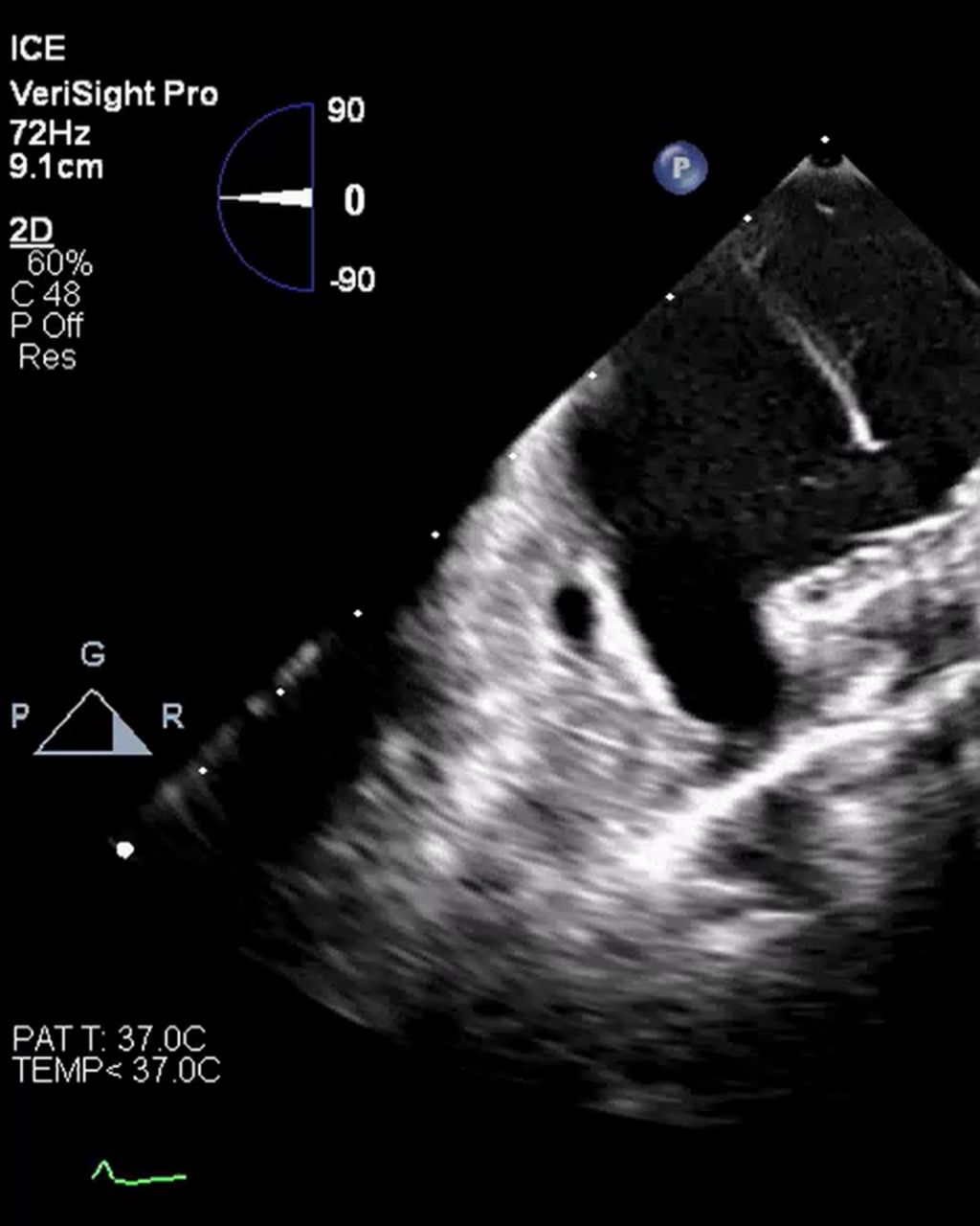 LAAO and Afib concomitant procedure with VeriSight Clinical Image