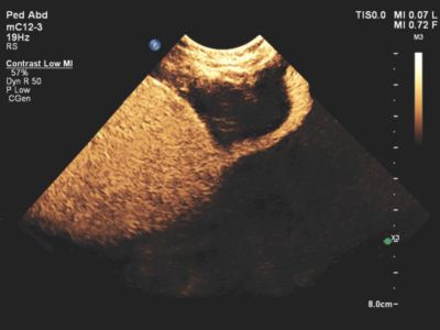 Contrast Enhanced Ultrasound (CEUS) | フィリップスヘルスケア