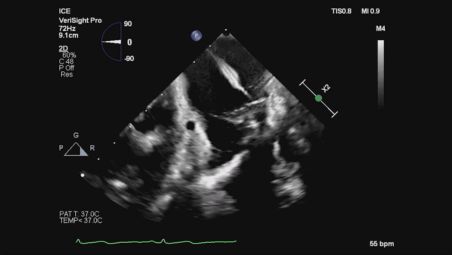 Simplify concomitant LAAO/ablation procedures video