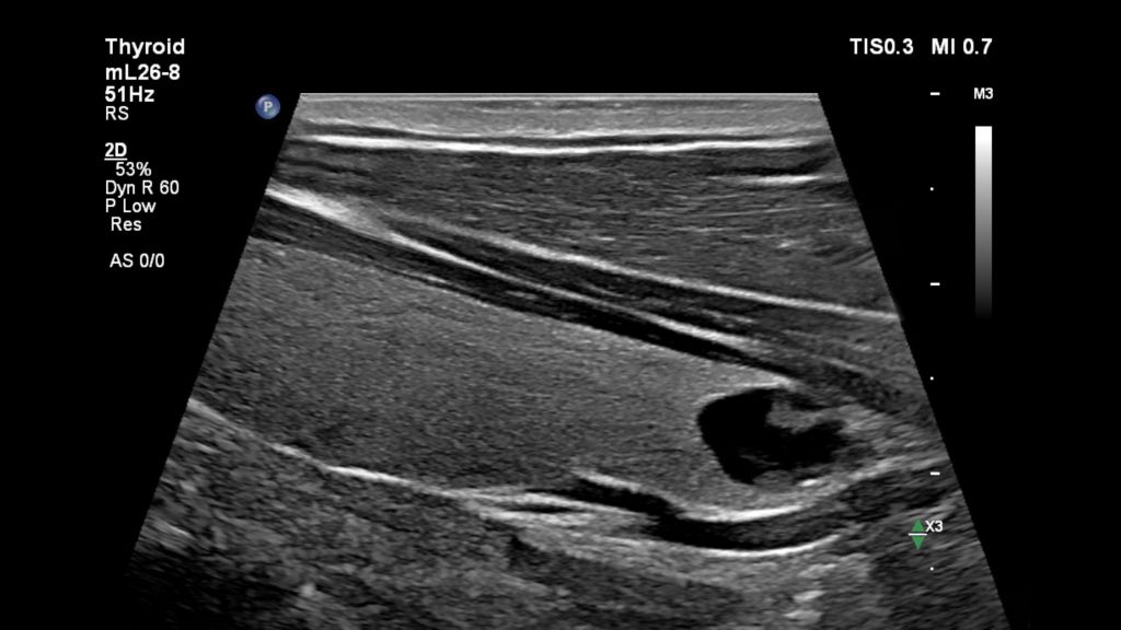 Thyroid Mass with Flow Viewer