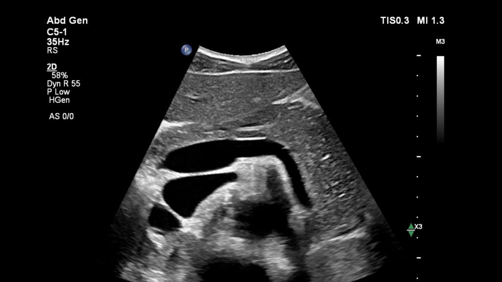Pancreas