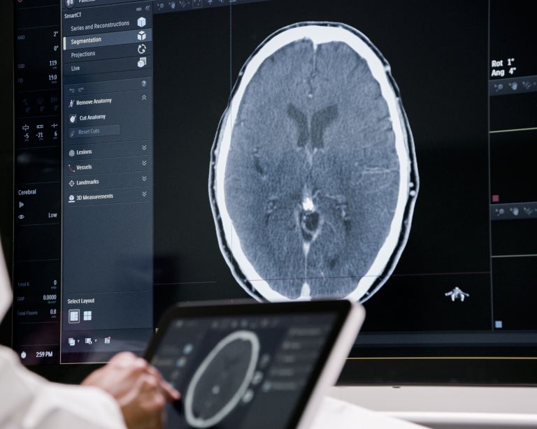 Ischemic stroke treatment