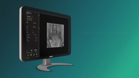 Digital Subtraction Angiography¹ - High quality vessel imaging video