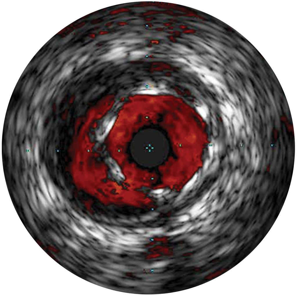 IVUS, a catheter-based imaging technology