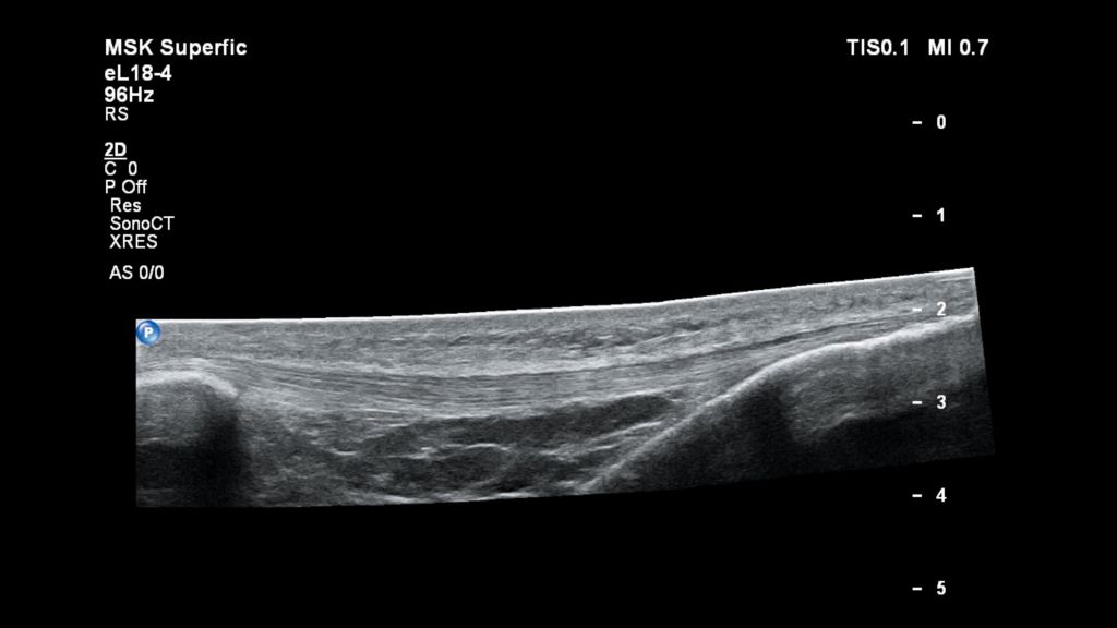 Patellar Tendon