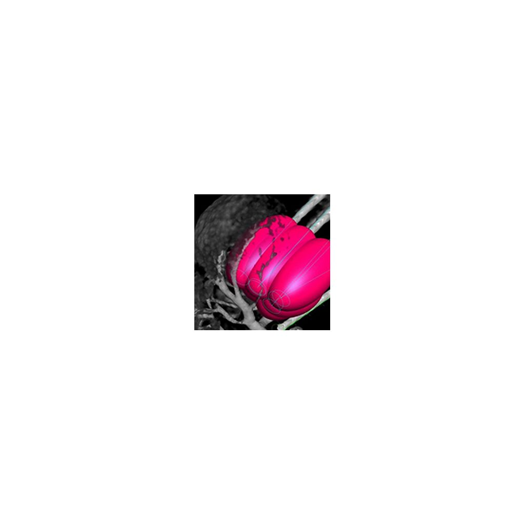 XperGuide Ablation