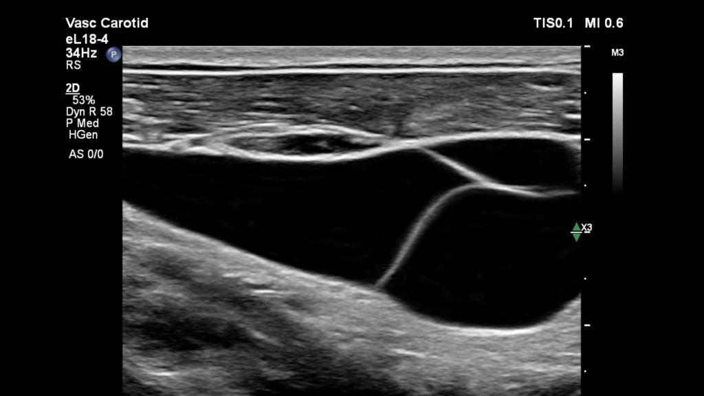Internal Jugular Vein