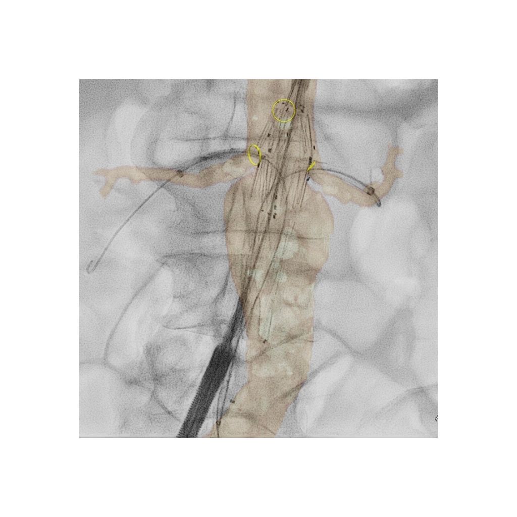 Philips VesselNavigator, a 3D roadmap overlay on a live X-ray image