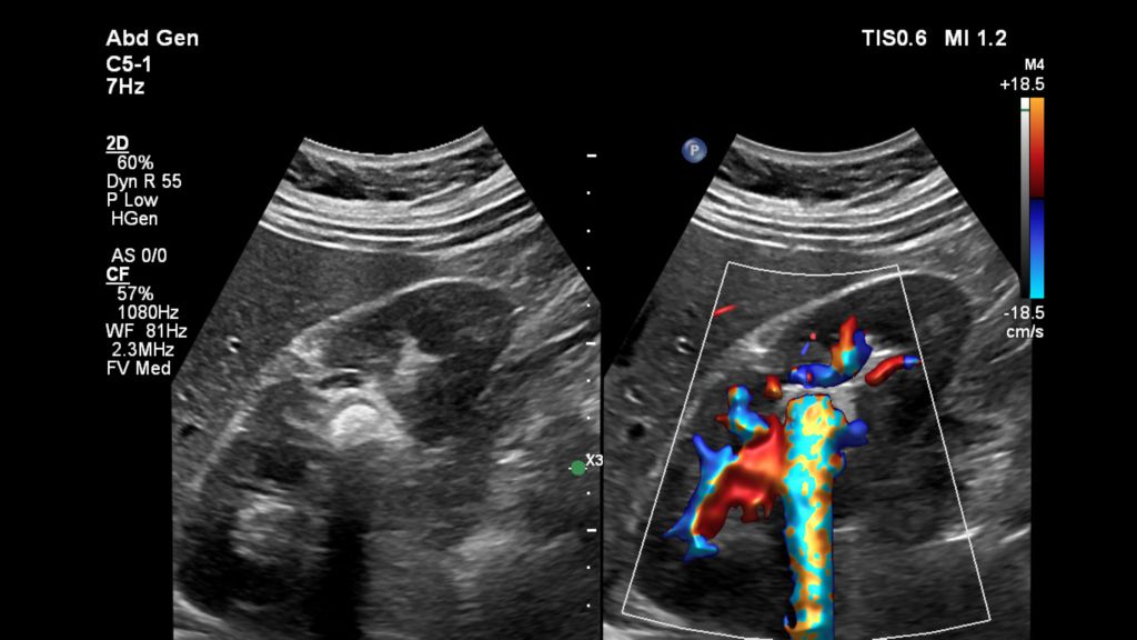 Kidney with Renal Stone