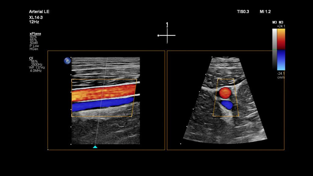 Femoral Artery