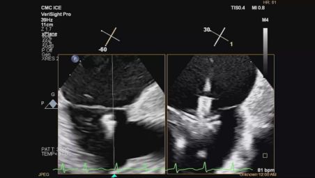 Enhance tricuspid care video