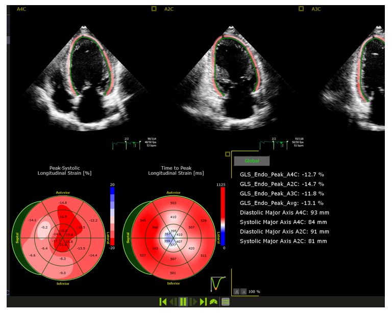 Image clinique - AutoStrain VG – Affiniti CVX