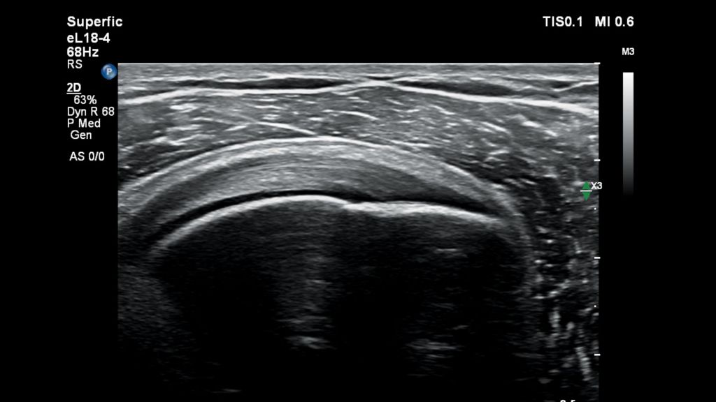Shoulder ultrasound