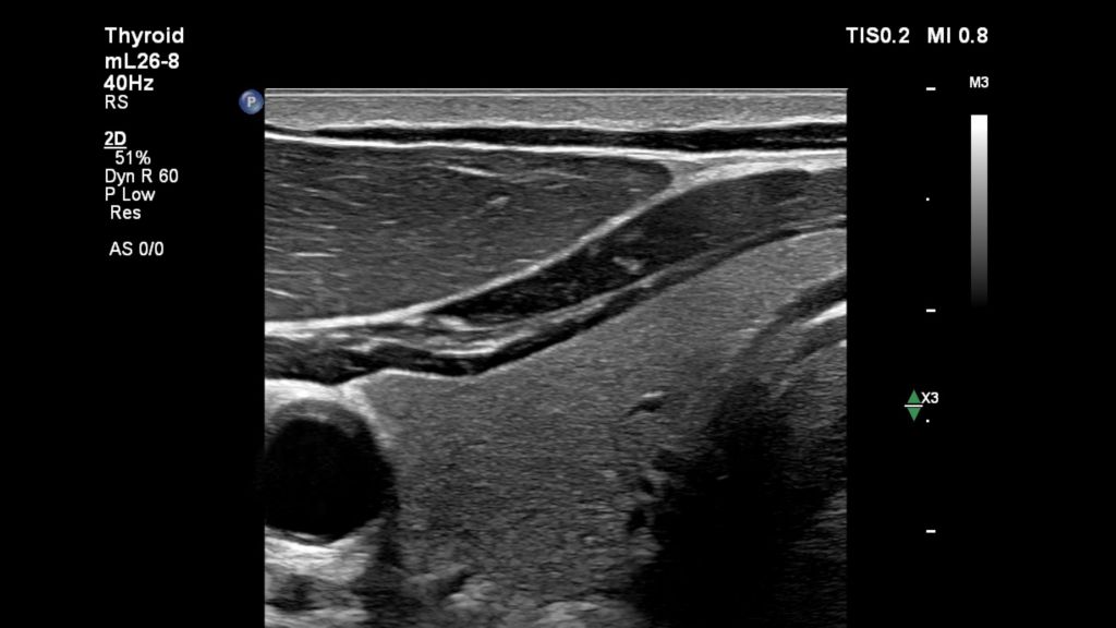 Thyroid with Flow Viewer