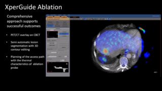 interventional oncology tumor ablation xperguide