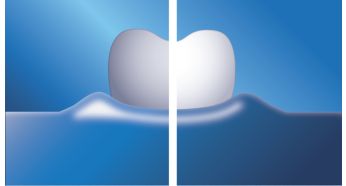 Your smile can be noticeably whiter