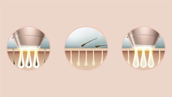 Derived from professional IPL, developed with dermatologists