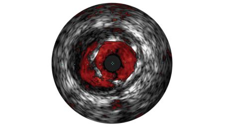 Evaluación de la aposición de stent ChromaFlo