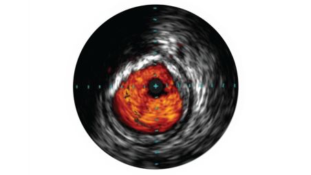 IVUS ayuda a evaluar la enfermedad 