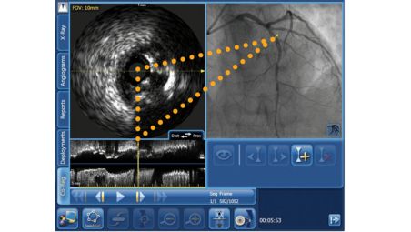 Localización del coregistro IVUS de SyncVision