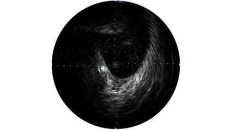 IVUS ayuda a evaluar la enfermedad