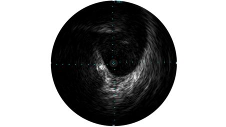 IVUS unterstützt bei der Einschätzung erkrankter Gefäße