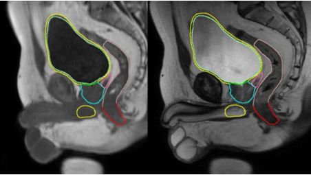 Reduce the need for manual contouring, while increasing consistency.