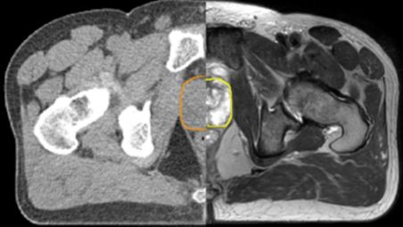 Enhance target contouring with MRI’s excellent soft-tissue contrast
