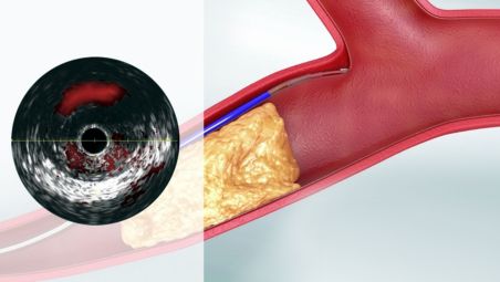 Minimize procedural complications