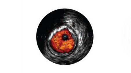 IVUS helps with disease assessment
