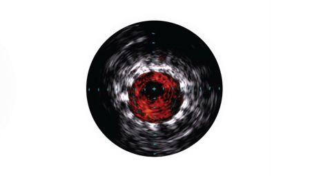 IVUS helps confirm treatment results