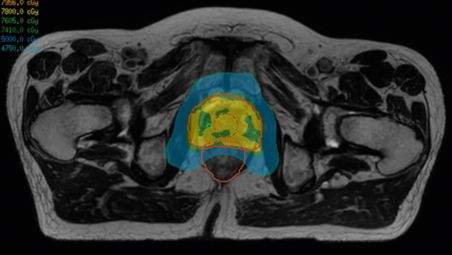 MR-only radiotherapy 