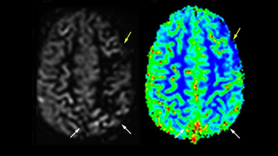 Neue Methoden für Neuro-MRT erhöhen Effizienz und Sicherheit