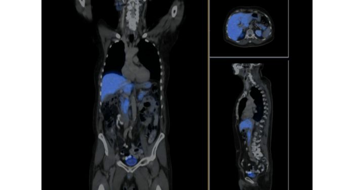 Time-of-Flight PET Imaging Technology | Philips