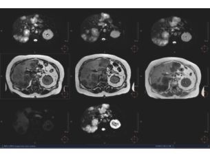 - Multi Modality Tumor Tracking