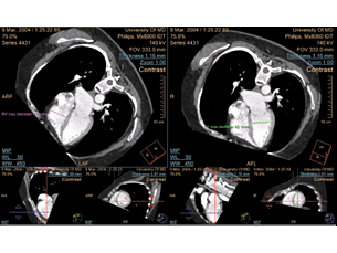- CT Pulmonary Artery Analysis (PAA)⁴